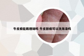 牛皮癣能戴珊瑚吗 牛皮肤癣可以洗海澡吗