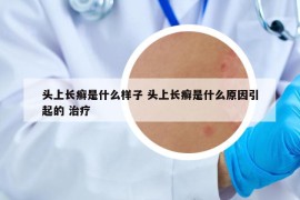 头上长癣是什么样子 头上长癣是什么原因引起的 治疗