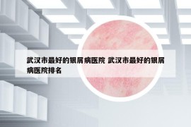 武汉市最好的银屑病医院 武汉市最好的银屑病医院排名