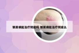 银屑病能治疗彻底吗 银屑病能治疗彻底么