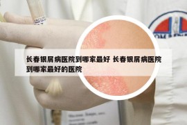 长春银屑病医院到哪家最好 长春银屑病医院到哪家最好的医院