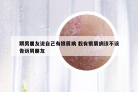 跟男朋友说自己有银屑病 我有银屑病该不该告诉男朋友