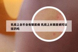 乳房上会不会有银屑病 乳房上长银屑病可以搽药吗