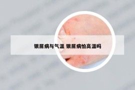 银屑病与气温 银屑病怕高温吗