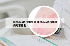 北京301医院银屑病 北京301医院银屑病专家排名