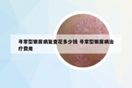 寻常型银屑病复查花多少钱 寻常型银屑病治疗费用