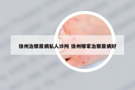 徐州治银屑病私人诊所 徐州哪家治银屑病好