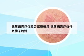 银屑病光疗仪能否家庭使用 银屑病光疗仪什么牌子的好