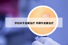 孕妇长牛皮廨治疗 孕期牛皮廨治疗