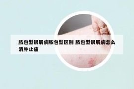 脓包型银屑病脓包型区别 脓包型银屑病怎么消肿止痛