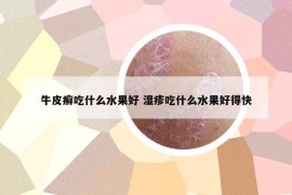 牛皮癣吃什么水果好 湿疹吃什么水果好得快