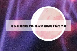 牛皮癣为啥晚上痒 牛皮银屑癣晚上痒怎么办