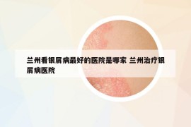 兰州看银屑病最好的医院是哪家 兰州治疗银屑病医院