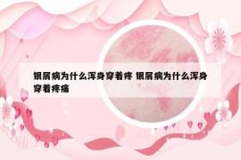 银屑病为什么浑身穿着疼 银屑病为什么浑身穿着疼痛