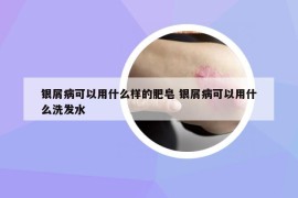 银屑病可以用什么样的肥皂 银屑病可以用什么洗发水