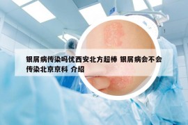 银屑病传染吗优西安北方超棒 银屑病会不会传染北京京科 介绍