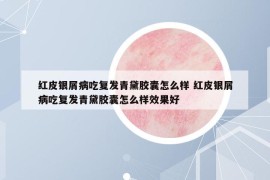 红皮银屑病吃复发青黛胶囊怎么样 红皮银屑病吃复发青黛胶囊怎么样效果好