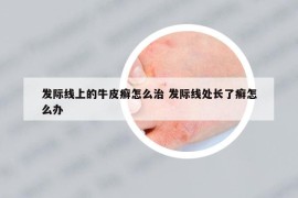 发际线上的牛皮癣怎么治 发际线处长了癣怎么办