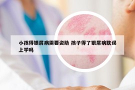 小孩得银屑病需要资助 孩子得了银屑病耽误上学吗