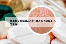 腿上起了癣结痂总不好 腿上长了藓好不了,怎么办