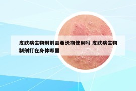 皮肤病生物制剂需要长期使用吗 皮肤病生物制剂打在身体哪里