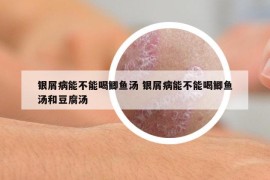 银屑病能不能喝鲫鱼汤 银屑病能不能喝鲫鱼汤和豆腐汤