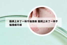 胳膊上长了一块干燥像癣 胳膊上长了一块干燥像癣不痒