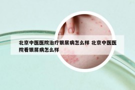 北京中医医院治疗银屑病怎么样 北京中医医院看银屑病怎么样