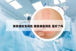 银屑病皮变褐色 银屑病变褐色 是好了吗