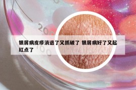 银屑病皮疹消退了又抓破了 银屑病好了又起红点了