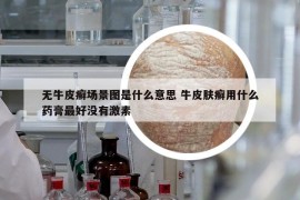 无牛皮癣场景图是什么意思 牛皮肤癣用什么药膏最好没有激素