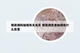 银屑病和抽烟有无关系 银屑病患者抽烟有什么危害