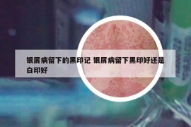 银屑病留下的黑印记 银屑病留下黑印好还是白印好