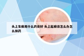 头上生癣用什么药膏好 头上起癣该怎么办怎么抹药