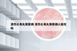 清热化毒丸银屑病 清热化毒丸银屑病人能吃吗