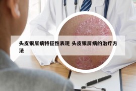 头皮银屑病特征性表现 头皮银屑病的治疗方法