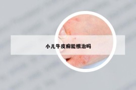 小儿牛皮癣能根治吗