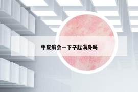 牛皮癣会一下子起满身吗