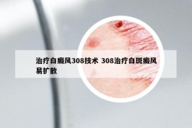 治疗白癜风308技术 308治疗白斑癜风易扩散