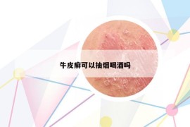 牛皮癣可以抽烟喝酒吗