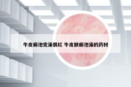 牛皮癣泡完澡很红 牛皮肤癣泡澡的药材