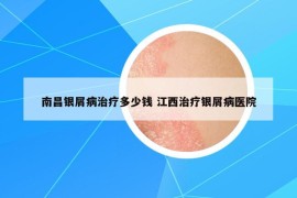 南昌银屑病治疗多少钱 江西治疗银屑病医院