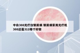 中白308光疗仪银屑病 银屑病家用光疗机308还是311哪个好些