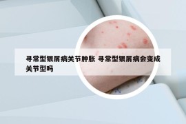 寻常型银屑病关节肿胀 寻常型银屑病会变成关节型吗