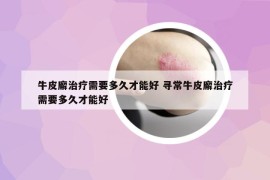 牛皮廨治疗需要多久才能好 寻常牛皮廨治疗需要多久才能好