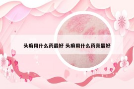 头癣用什么药最好 头癣用什么药膏最好