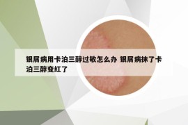 银屑病用卡泊三醇过敏怎么办 银屑病抹了卡泊三醇变红了