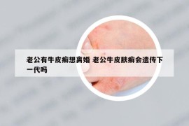 老公有牛皮癣想离婚 老公牛皮肤癣会遗传下一代吗