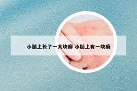 小腿上长了一大块癣 小腿上有一块癣