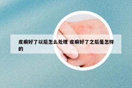 皮癣好了以后怎么处理 皮癣好了之后是怎样的